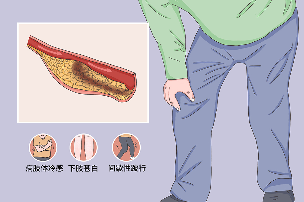 双下肢动脉硬化图片图片