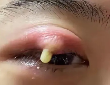 囊肿图片眼睛肿眼疖子眼睛肿眼皮肿是怎么回事啊眼睛长火疖子图片眼睛