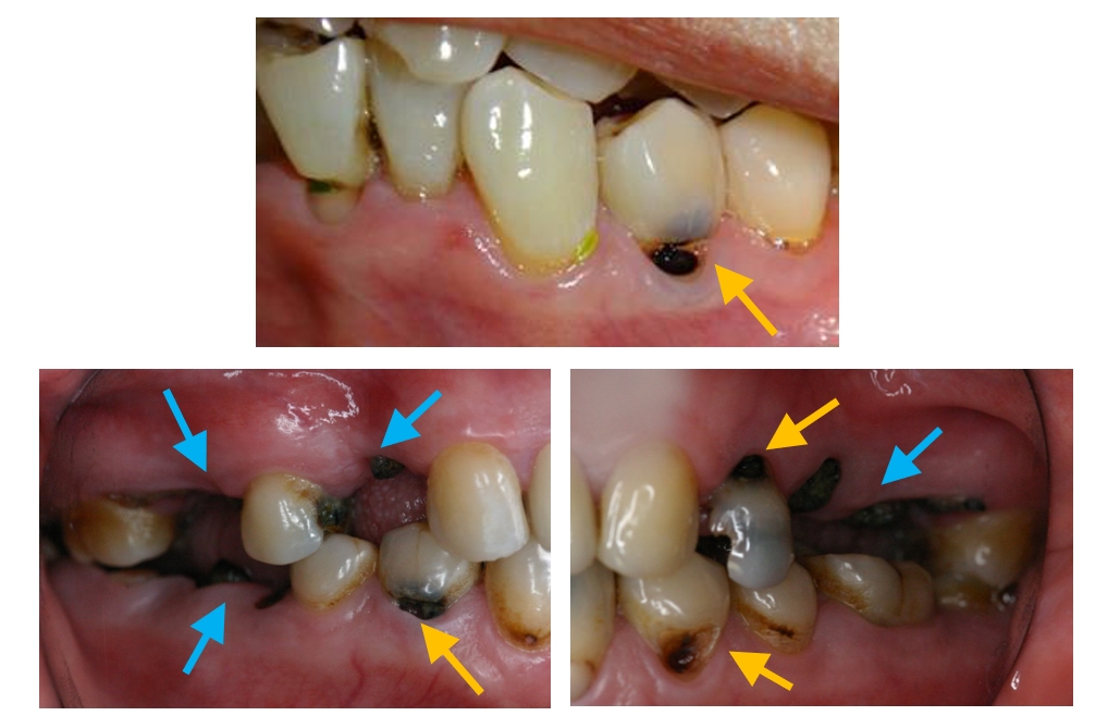 积极防治牙根面龋