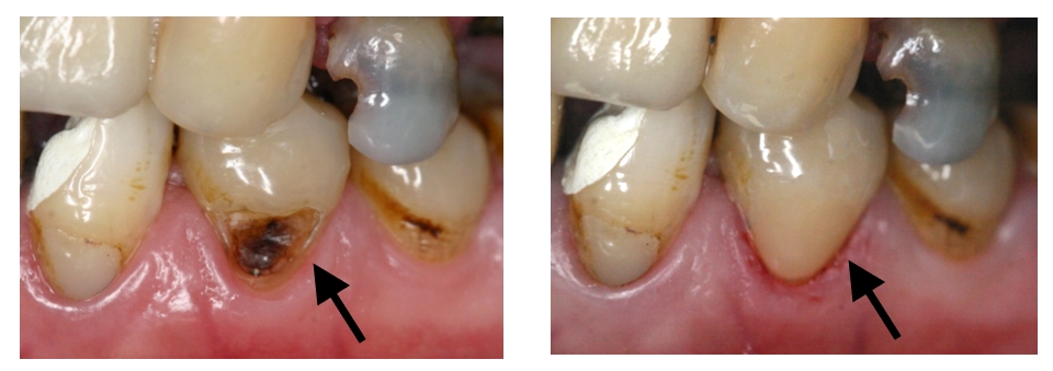 积极防治牙根面龋