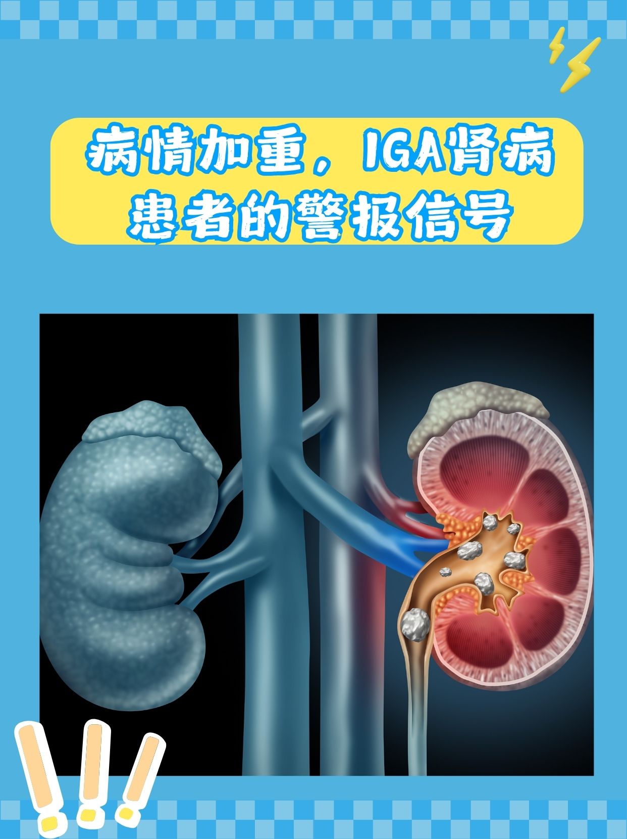 病情加重,iga肾病患者的警报信号