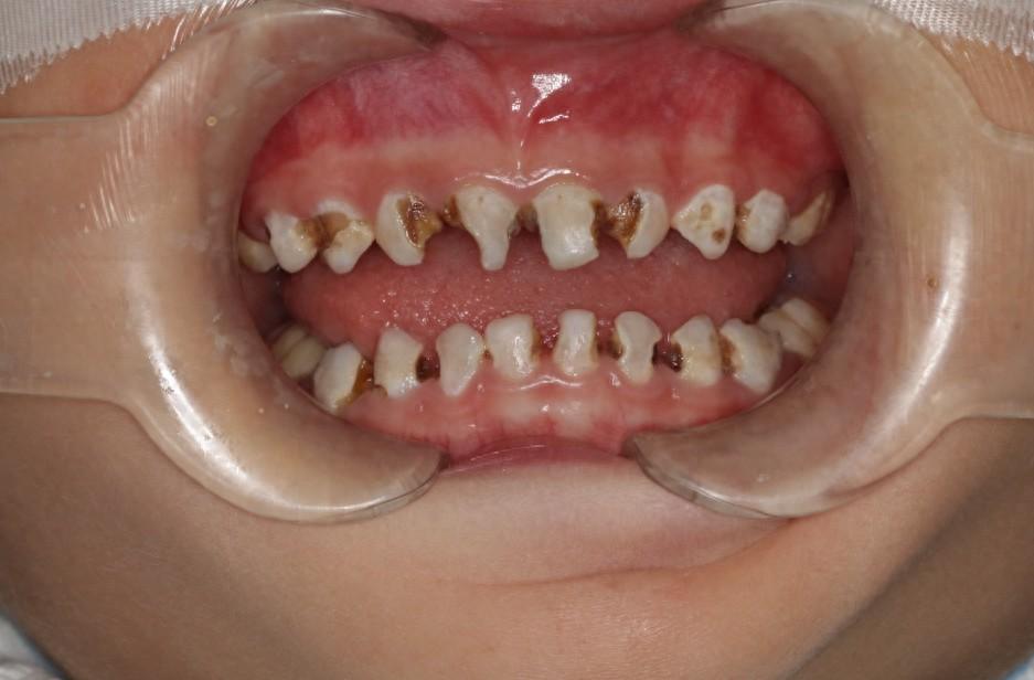 女孩爱吃甜食导致一嘴"烂牙",这种治疗方式为其带来"口福"!