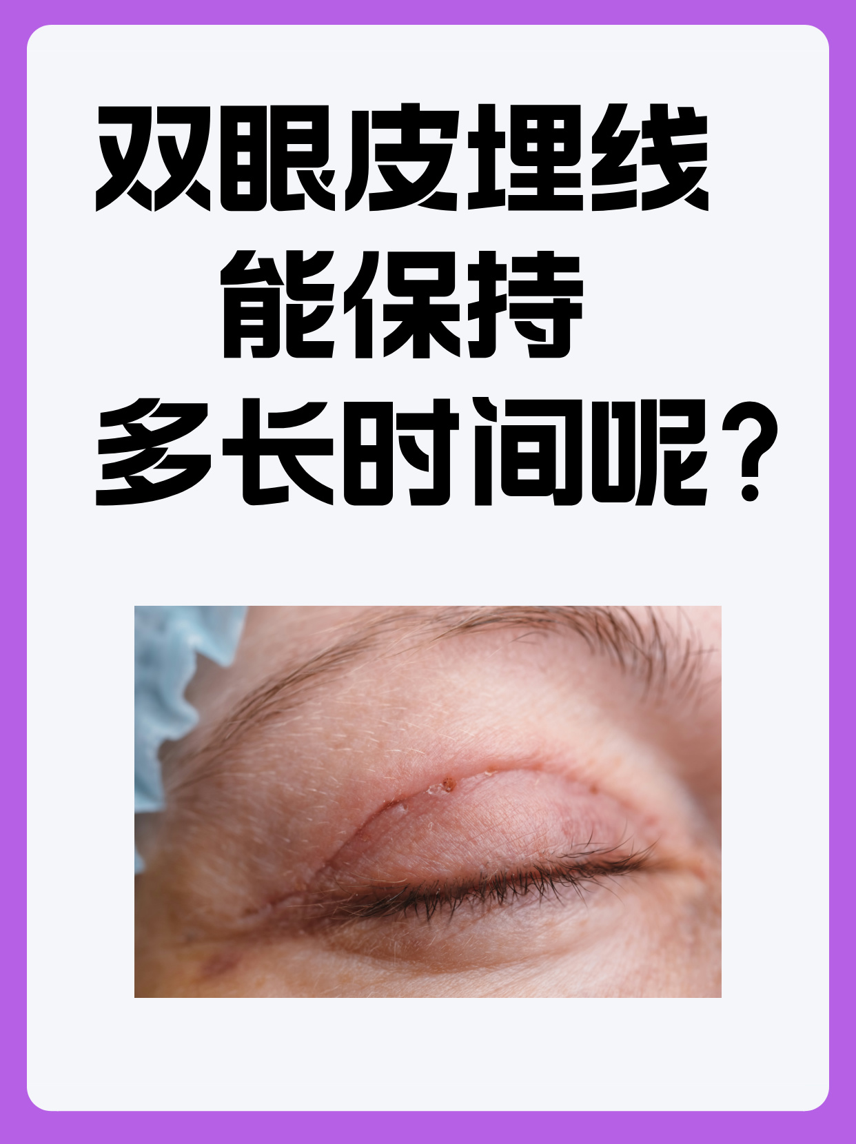 双眼皮埋线