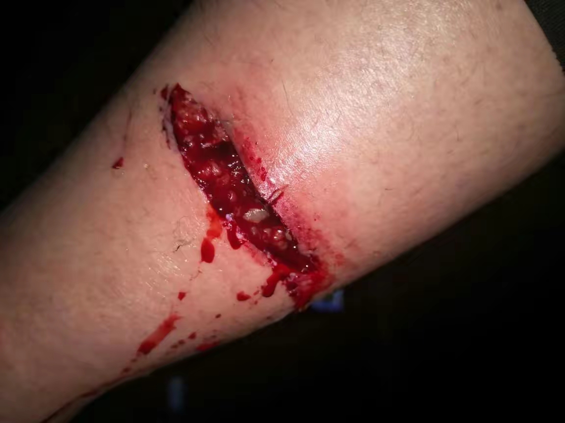 出血图片腿上都是血腿出血的图片真实一点的车里的血收割机受伤图片