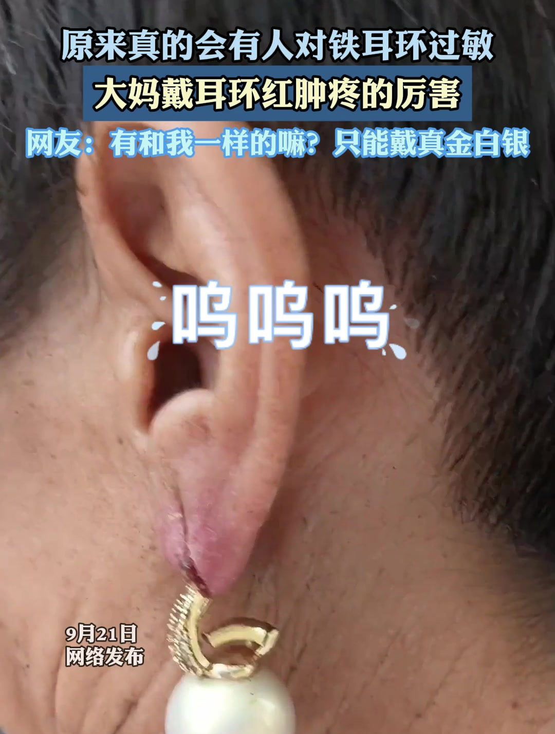 原来真的会有人对铁耳环过敏,大妈戴耳环红肿疼的厉害