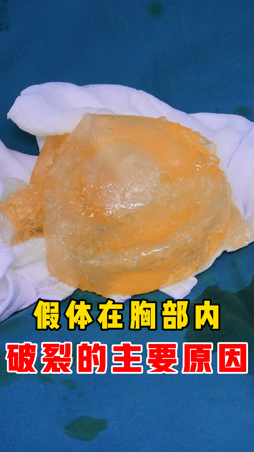 如何判断假体在胸里发生了破裂?