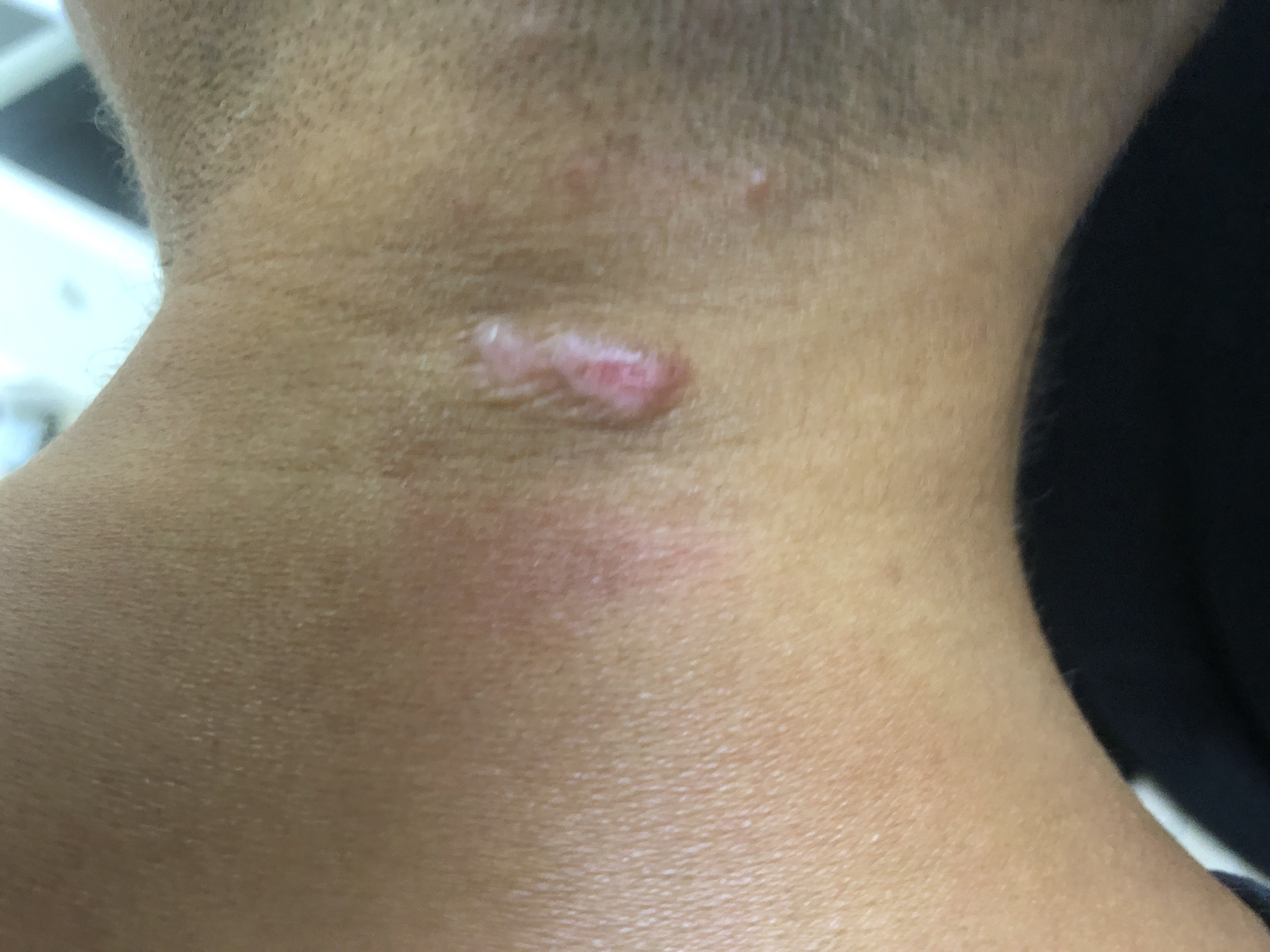 瘤图片脖子后面血管有斑块皮肤棘状增生图片头部部皮肤层结节怎么治疗