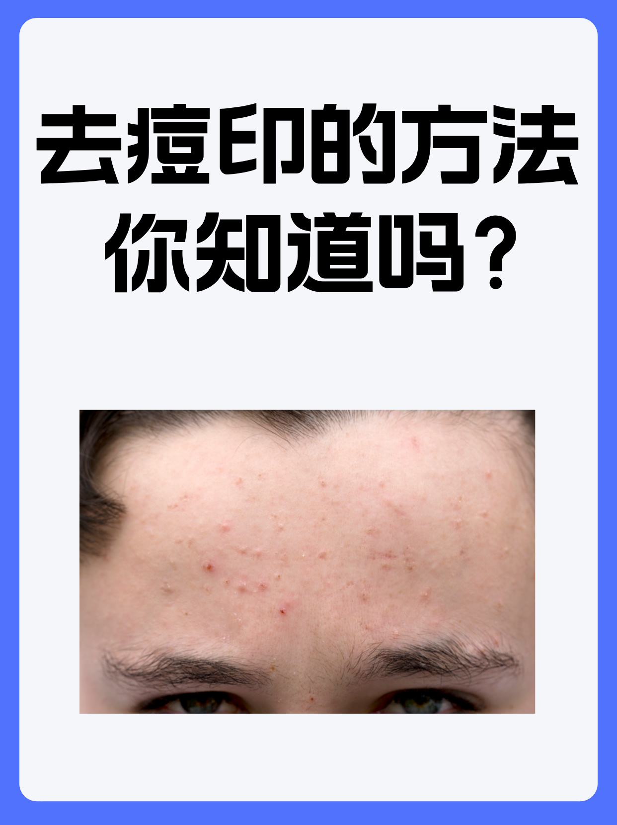 去痘印的方法,你知道吗?