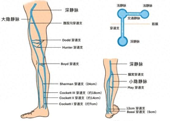 静脉曲张要想不复发,穿通支检查一定要做,是影响病情恢复的关键