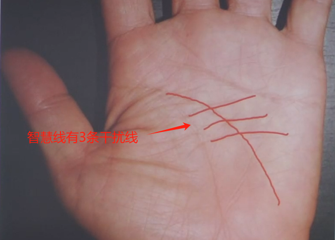 一头痛智慧线上有方纹一受伤性头痛智慧线有岛纹,头晕生命线下部有三
