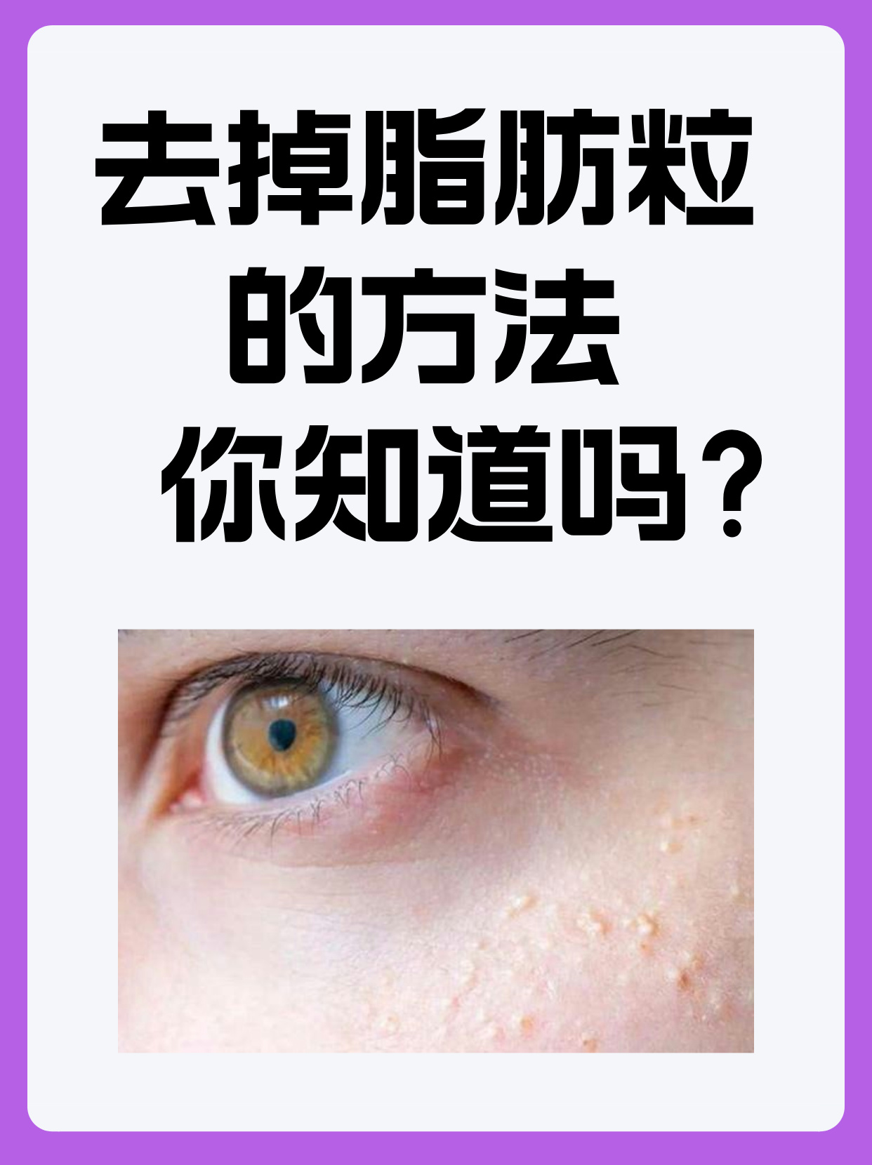 去脂肪粒最有效的方法图片