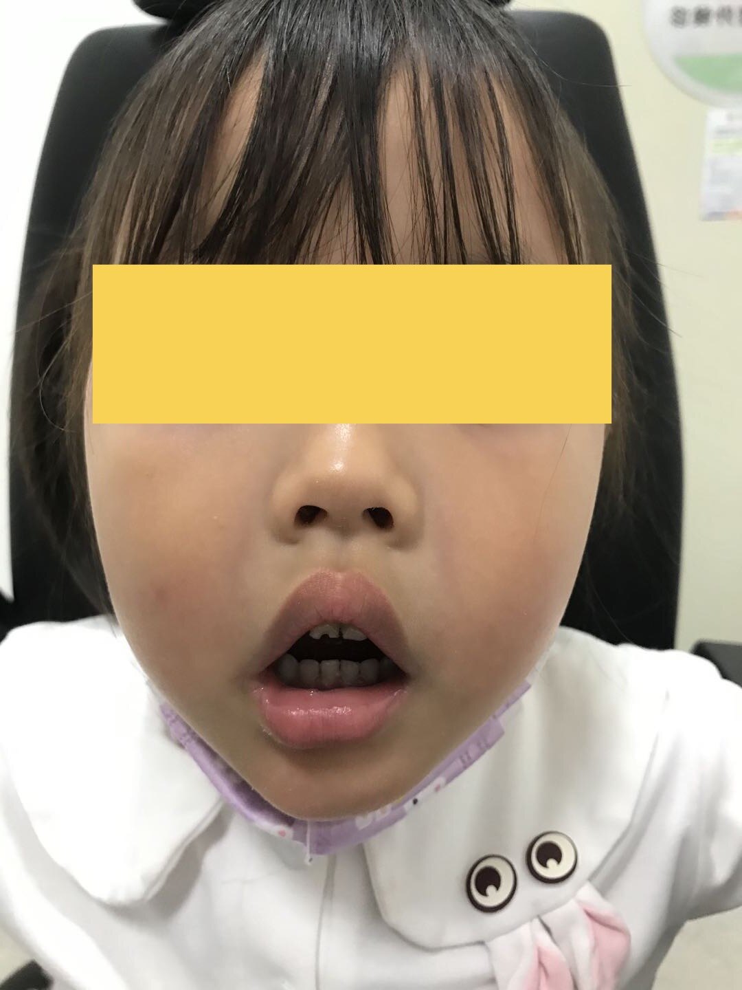 1,孩子腺样体肥大,即便不到80%很多西医也会建议手术切除