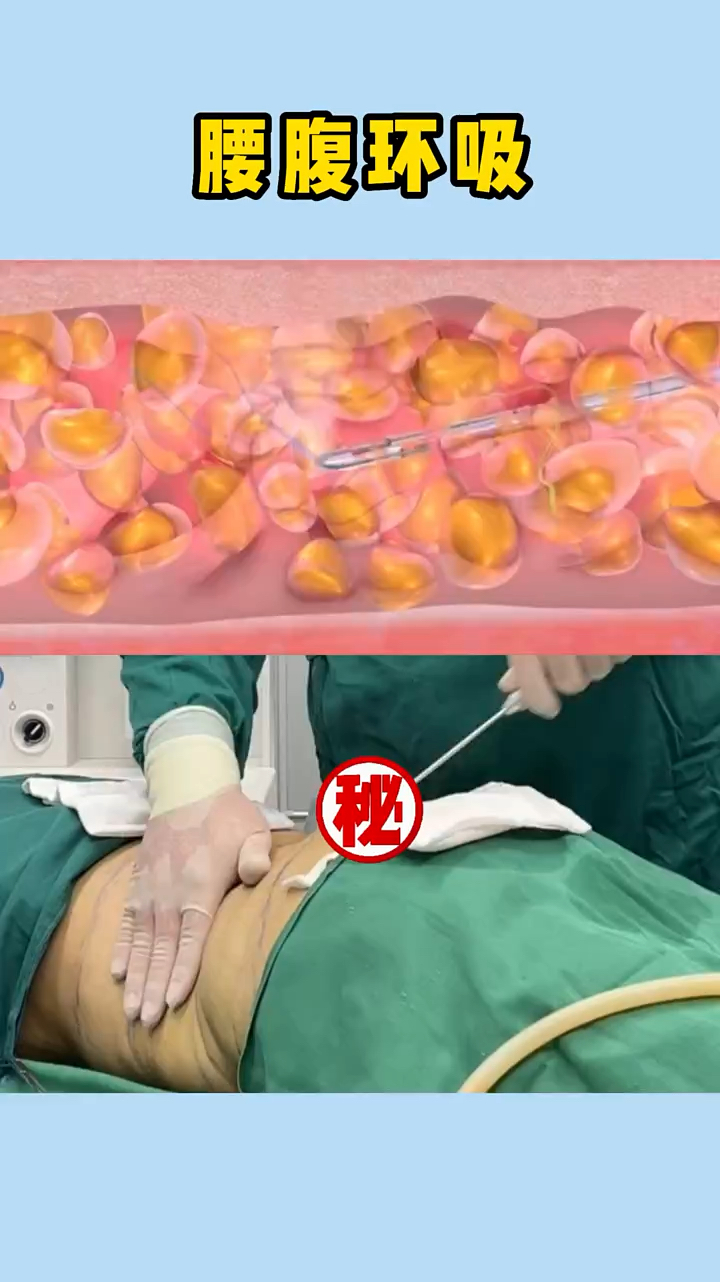 腰腹环吸术后即刻小蛮腰