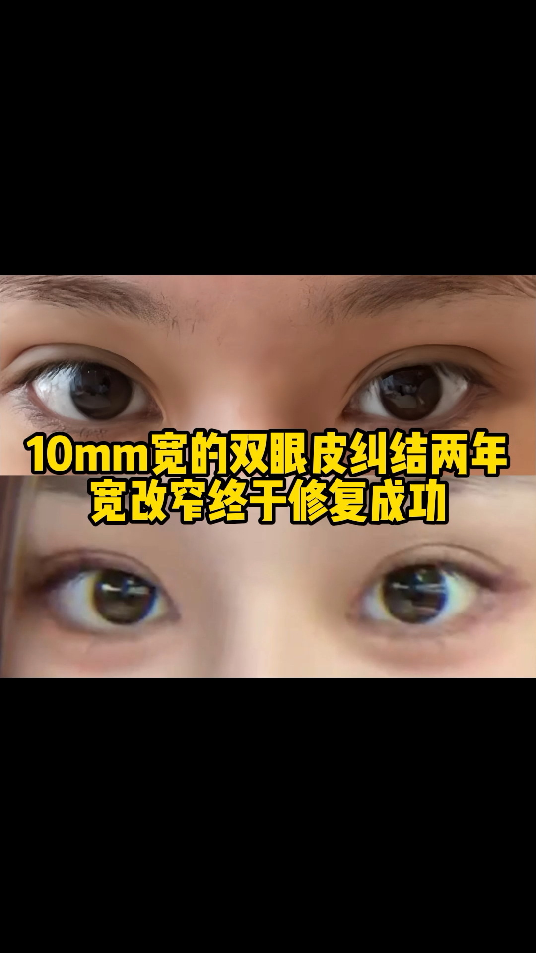 10mm宽的双眼皮纠结两年,宽改窄终于修复成功!