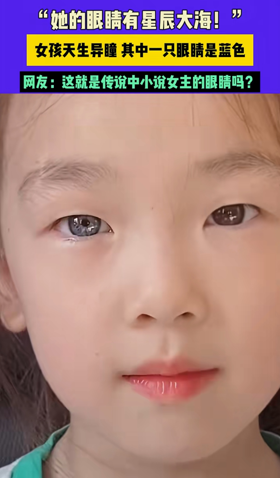 近日,湖南长沙一个女孩天生一只眼睛是蓝色瞳孔,引起网友围观