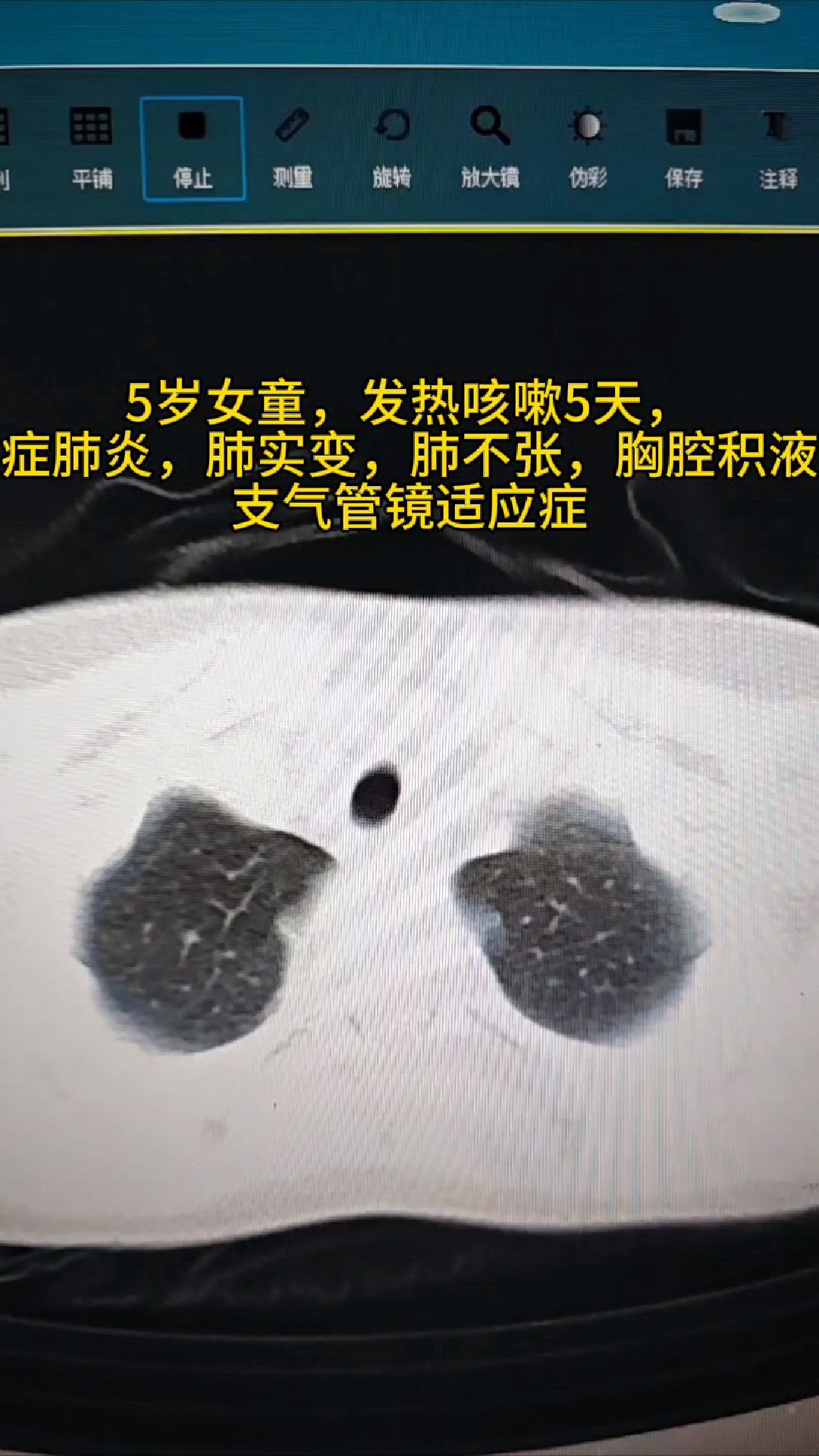 5岁女童,高热数日,重症肺炎(肺实变,肺不张)支气管镜适应症