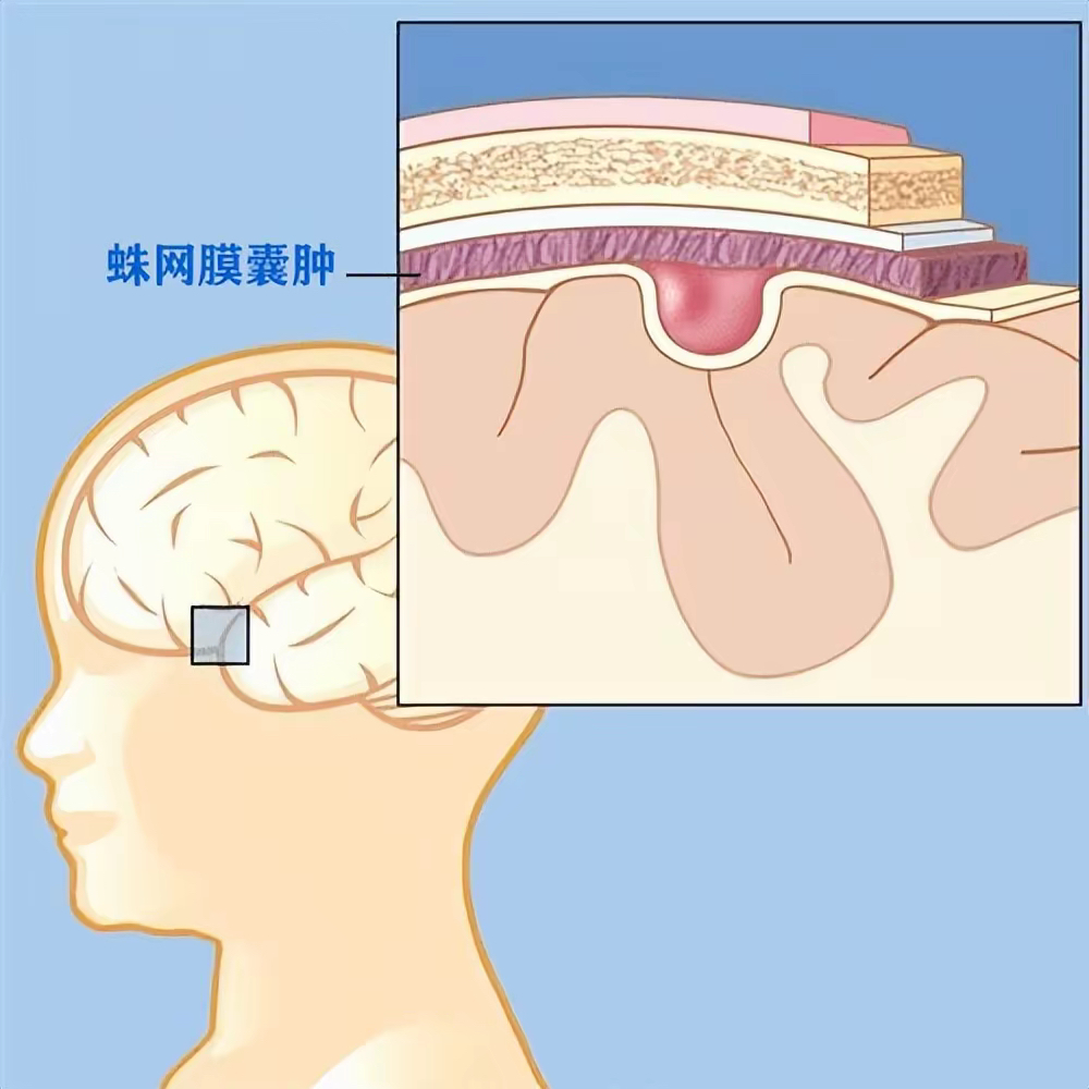 蛛网膜囊肿图片症状图片