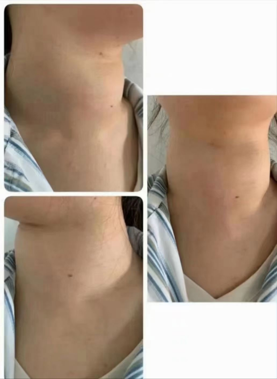 桥本甲状腺炎西医没有针对性药物去治疗就说没事,真的就有人相信了吗
