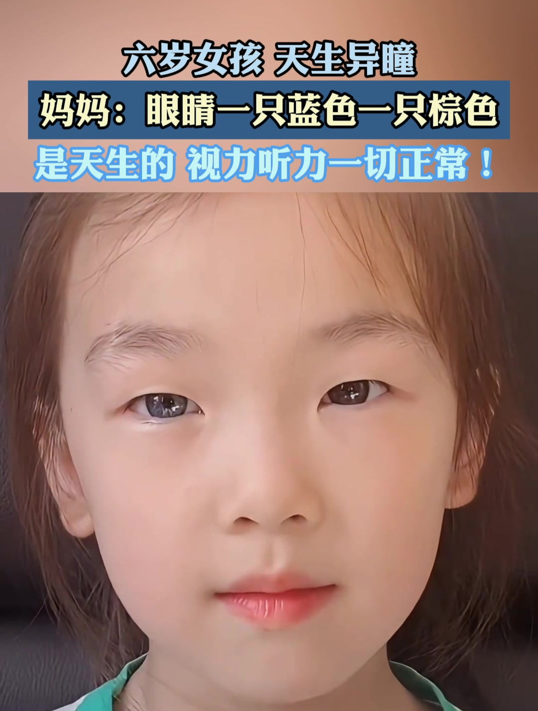 六岁女孩天生异瞳,眼睛一只蓝色,一只棕色
