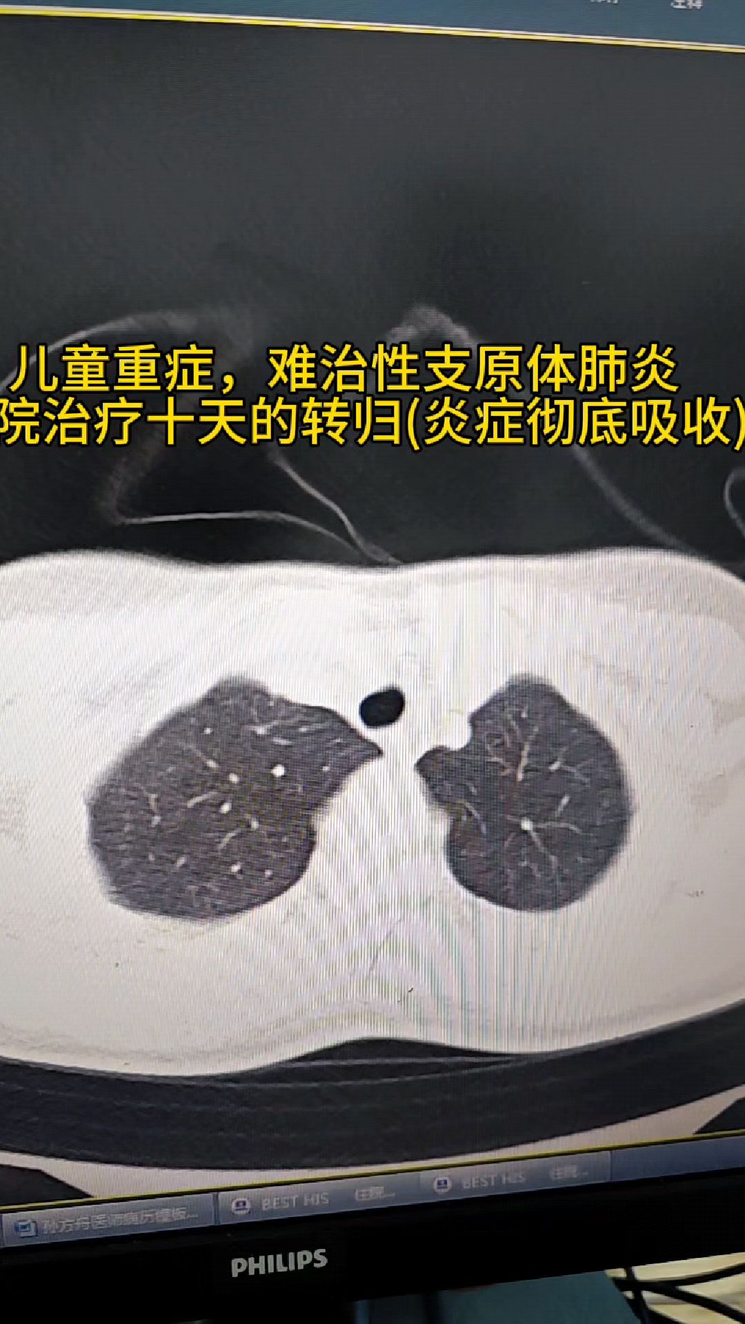 收治11岁女童难治性支原体肺炎,重症肺炎住院治疗10天后转归复查