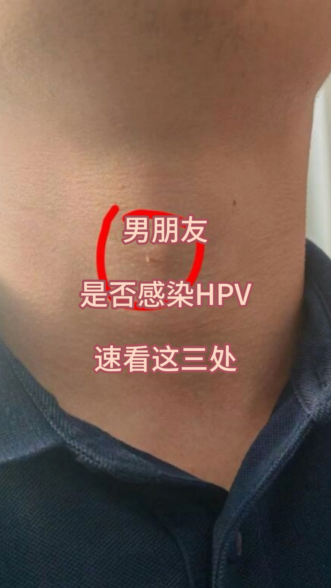 男朋友是否感染hpv,速看这三处