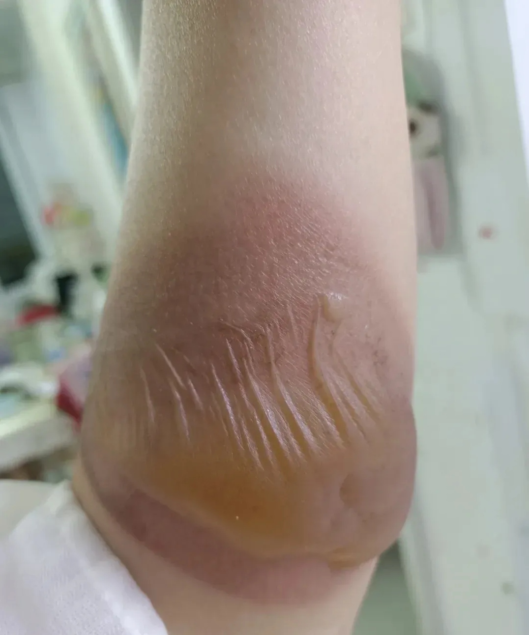 我妹妹不小心把手臂给烫了,没多久就起了个很大的水泡,我告诉她过几天