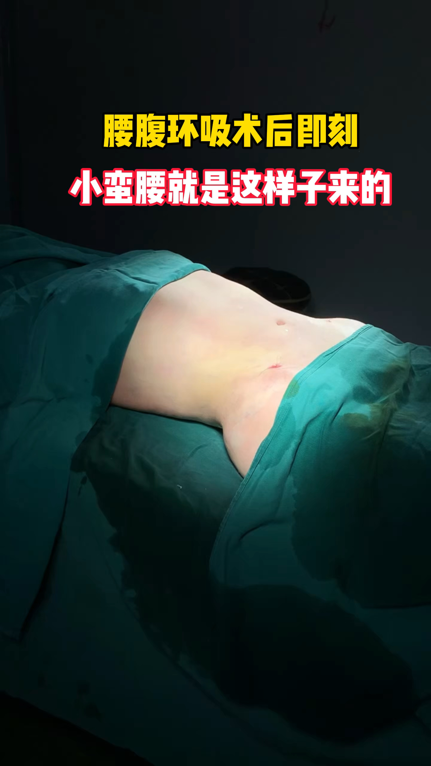 腰腹环吸术后即刻,小蛮腰就是这样来的