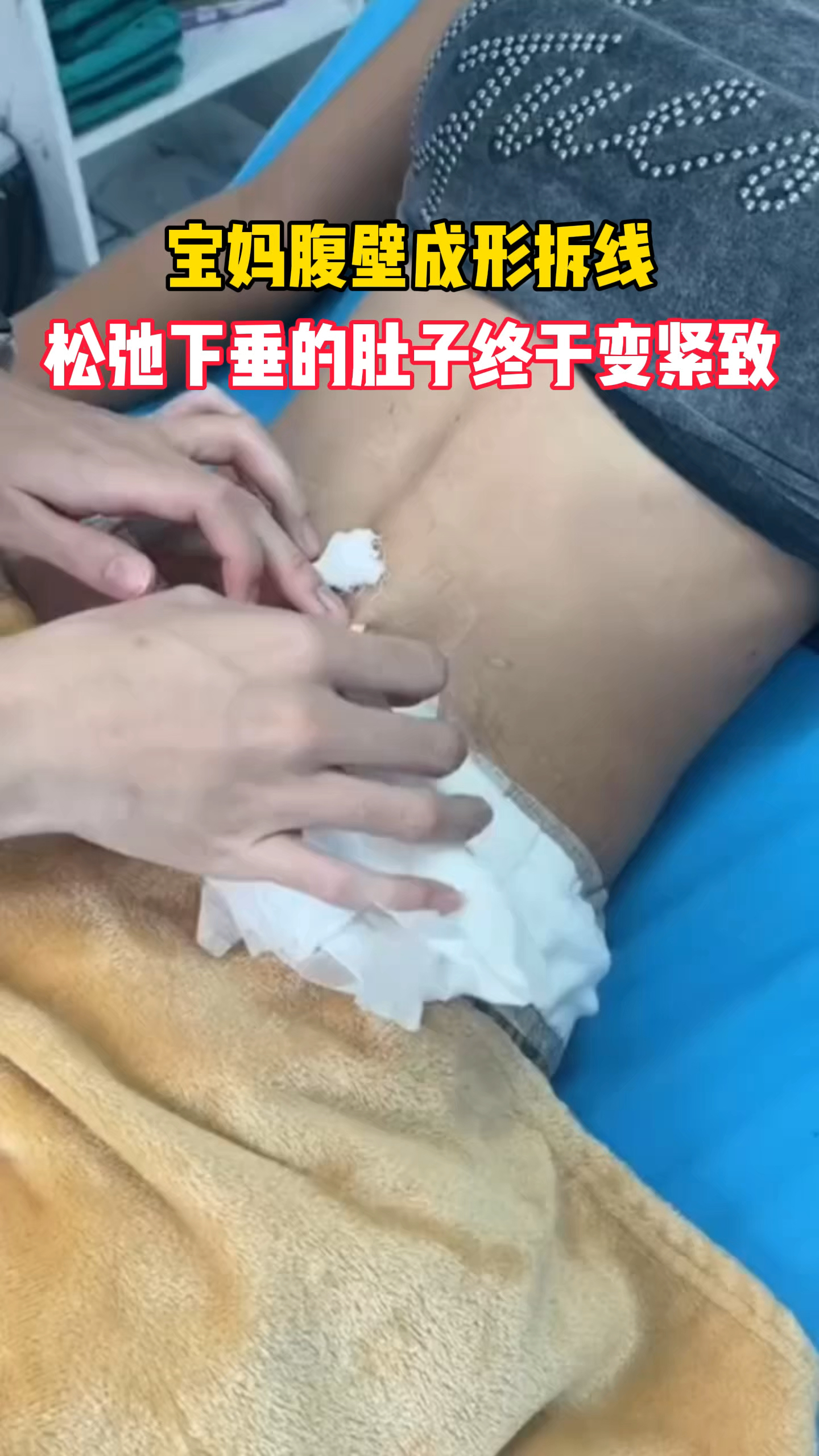 宝妈腹壁成形来拆线