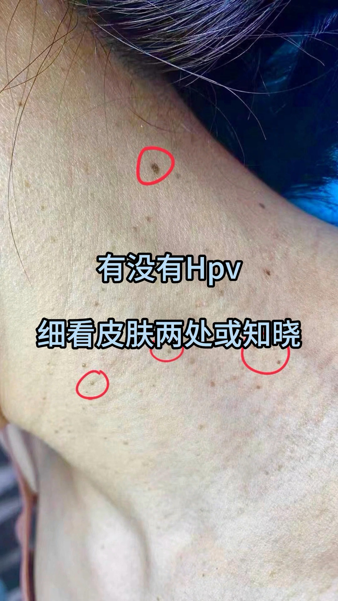 有没有hpv,细看皮肤两处或知晓