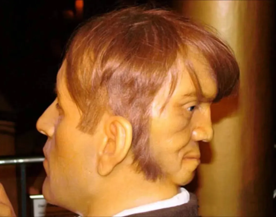 双面人,医学上称为颅部寄生胎联胎:在双胞胎发育过程中,一个吸收了另