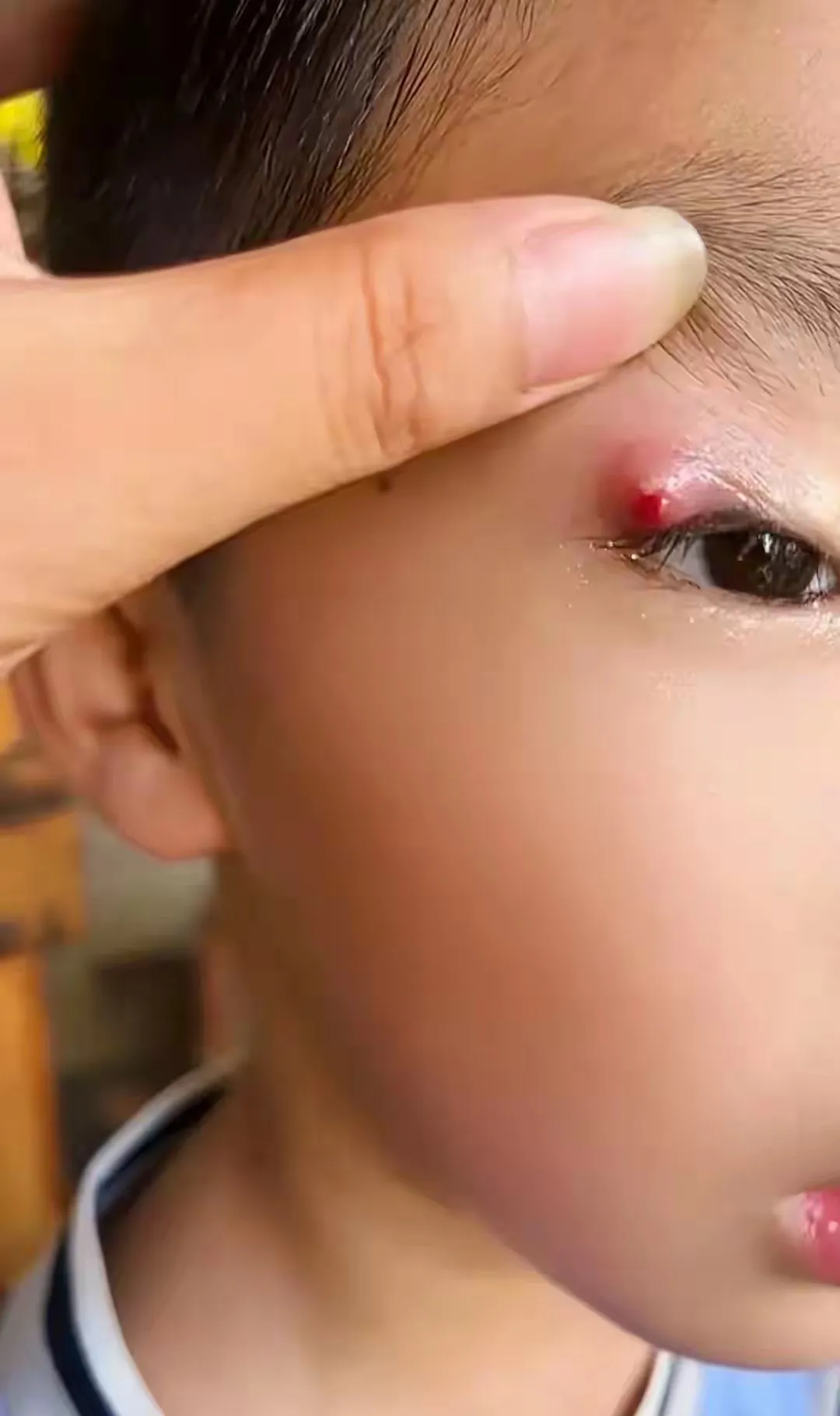 孩子妈妈去医院咨询眼皮长个小疙瘩是怎么回事眼疖子眼疖子图片眼角