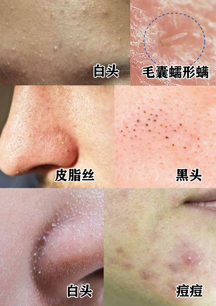 为什么长粉刺