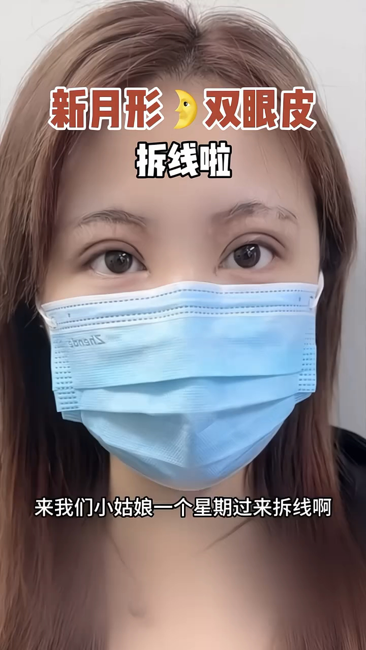 新月形双眼皮术后拆线了