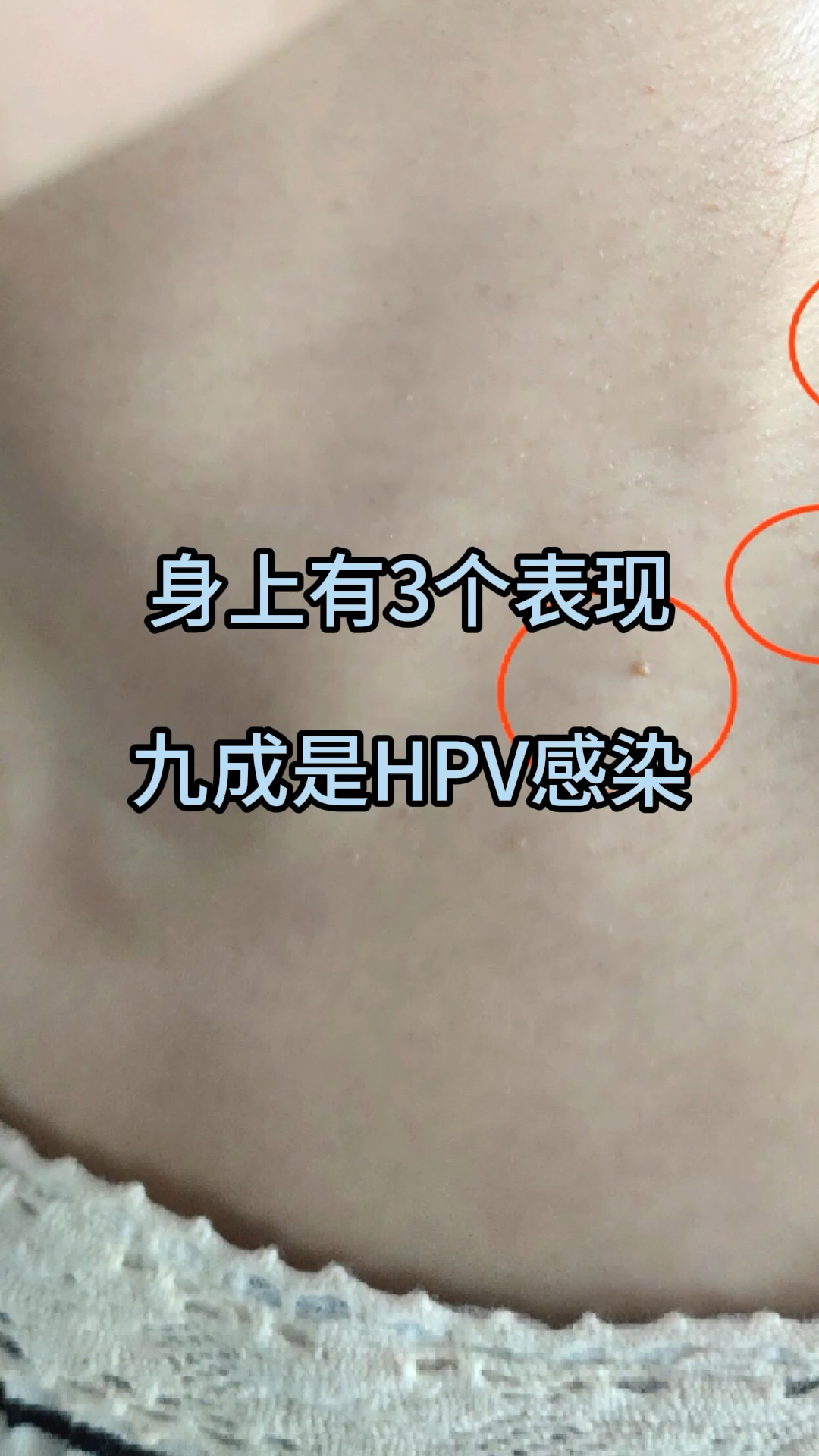 身上有3个表现,九成是hpv感染