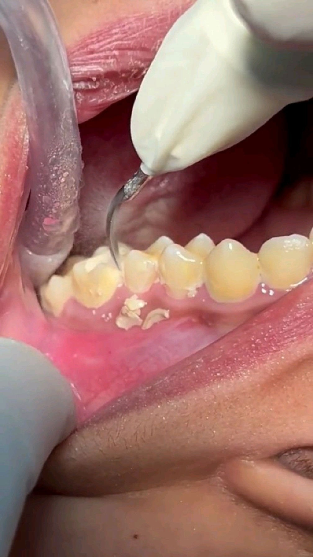 清理牙垢牙结石解压