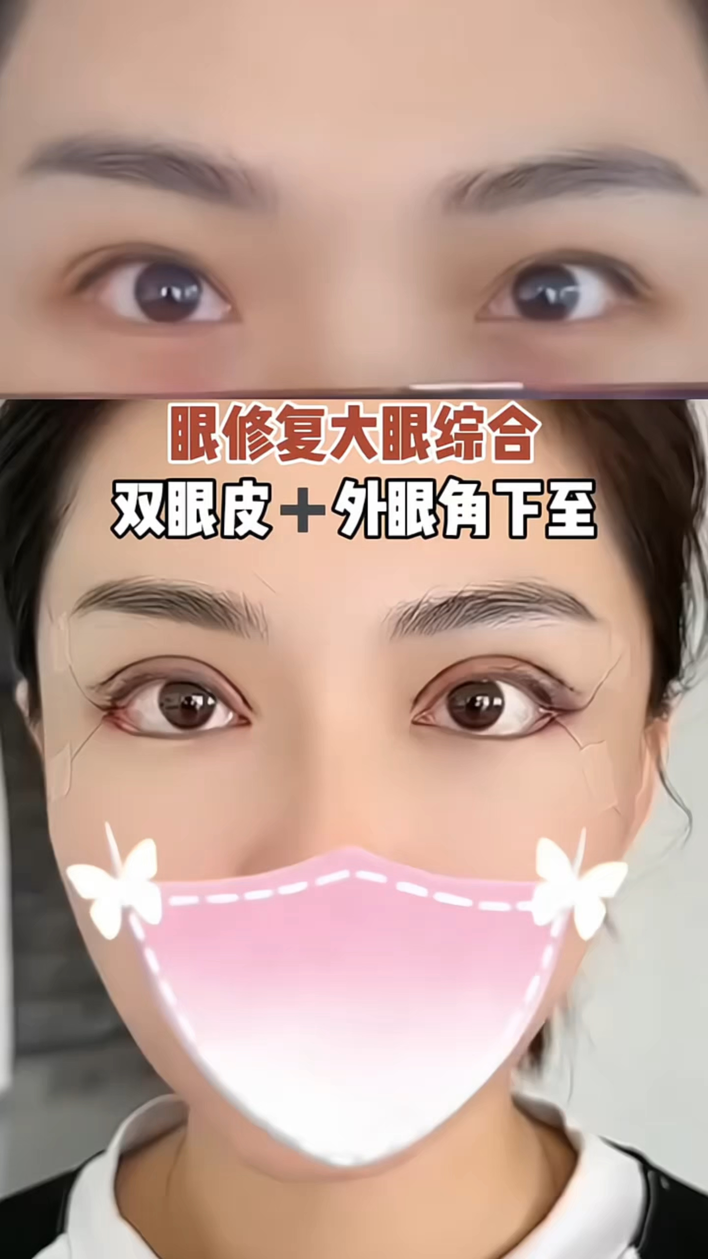 眼修复大眼综合,双眼皮 外眼角下至