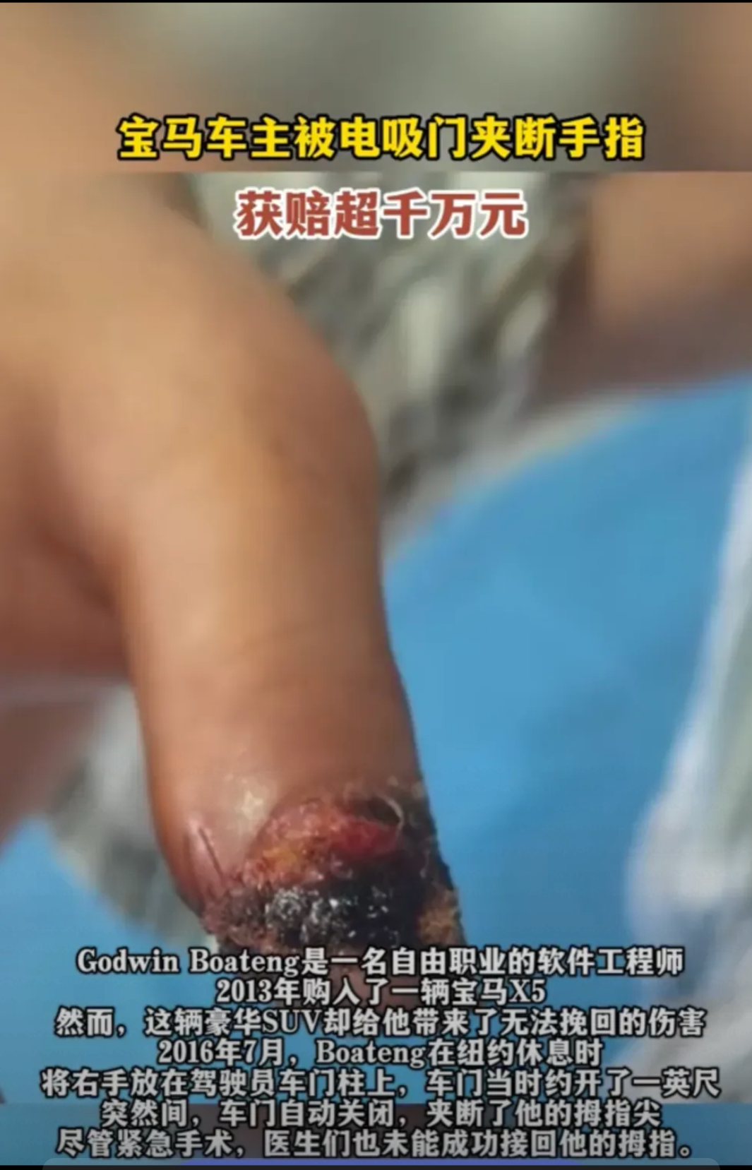 手指工伤十级伤残图片手指缺失10级伤残图片右手拇指十级工伤图大拇指