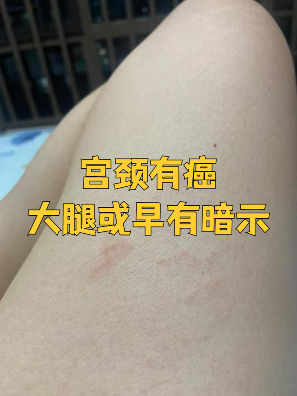 宫颈是否有ai,看看大腿或知道 说到hpv病毒,相信很多女性都不陌生,大