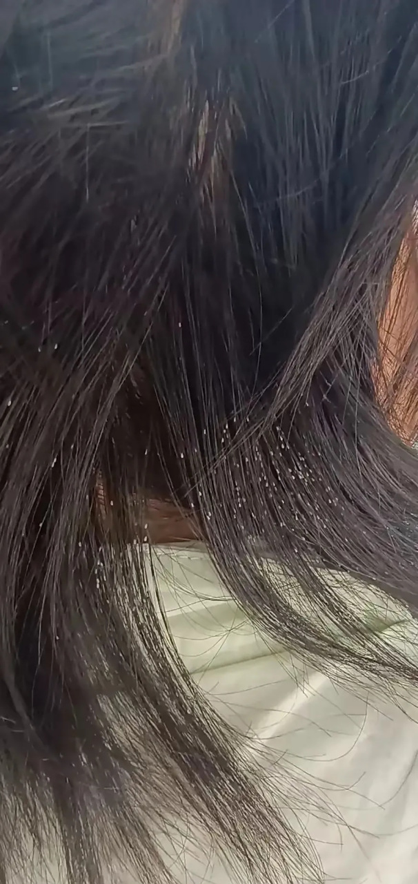 受不了 排队卖豆浆 发现一个女生头发上 具然密密麻麻的爬满了虱卵