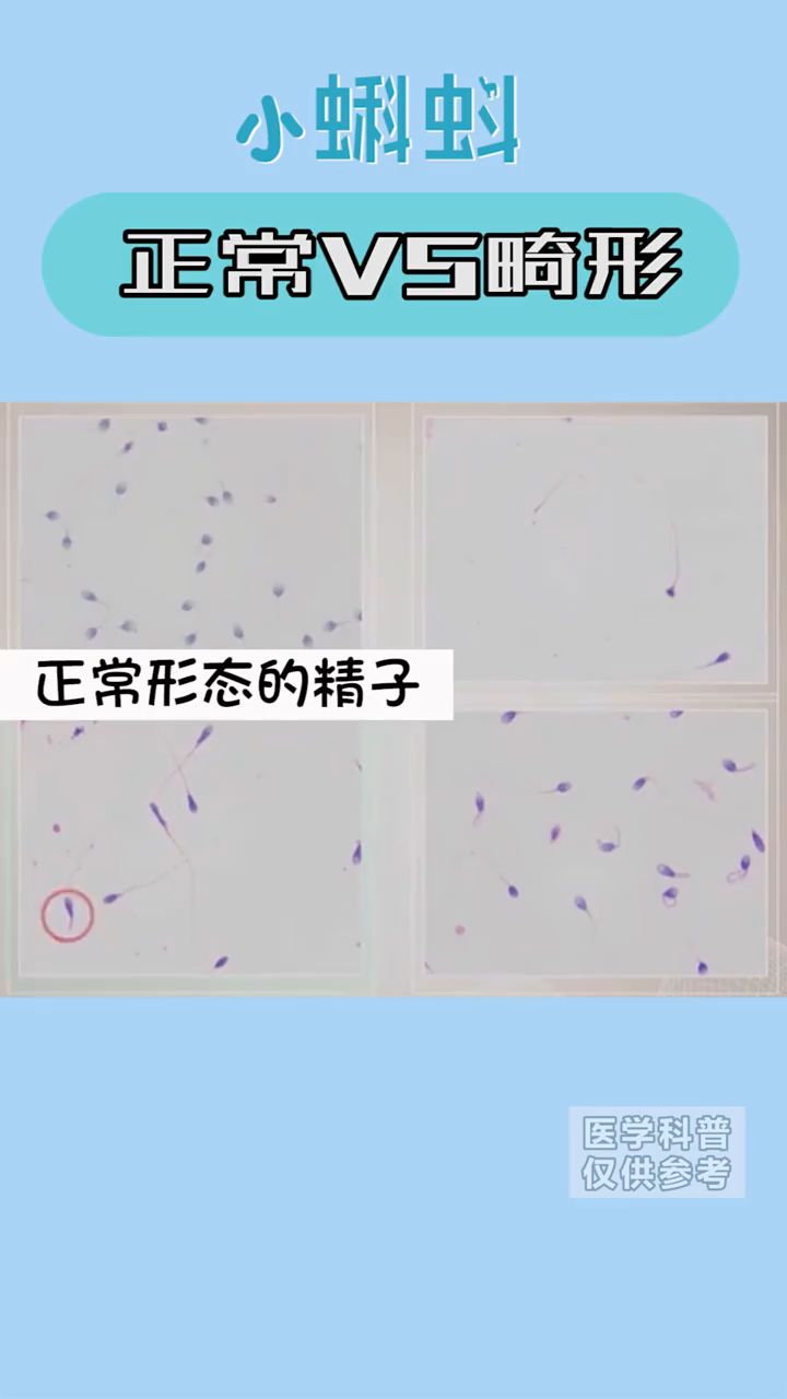 畸形精子的有几种,你知道吗?