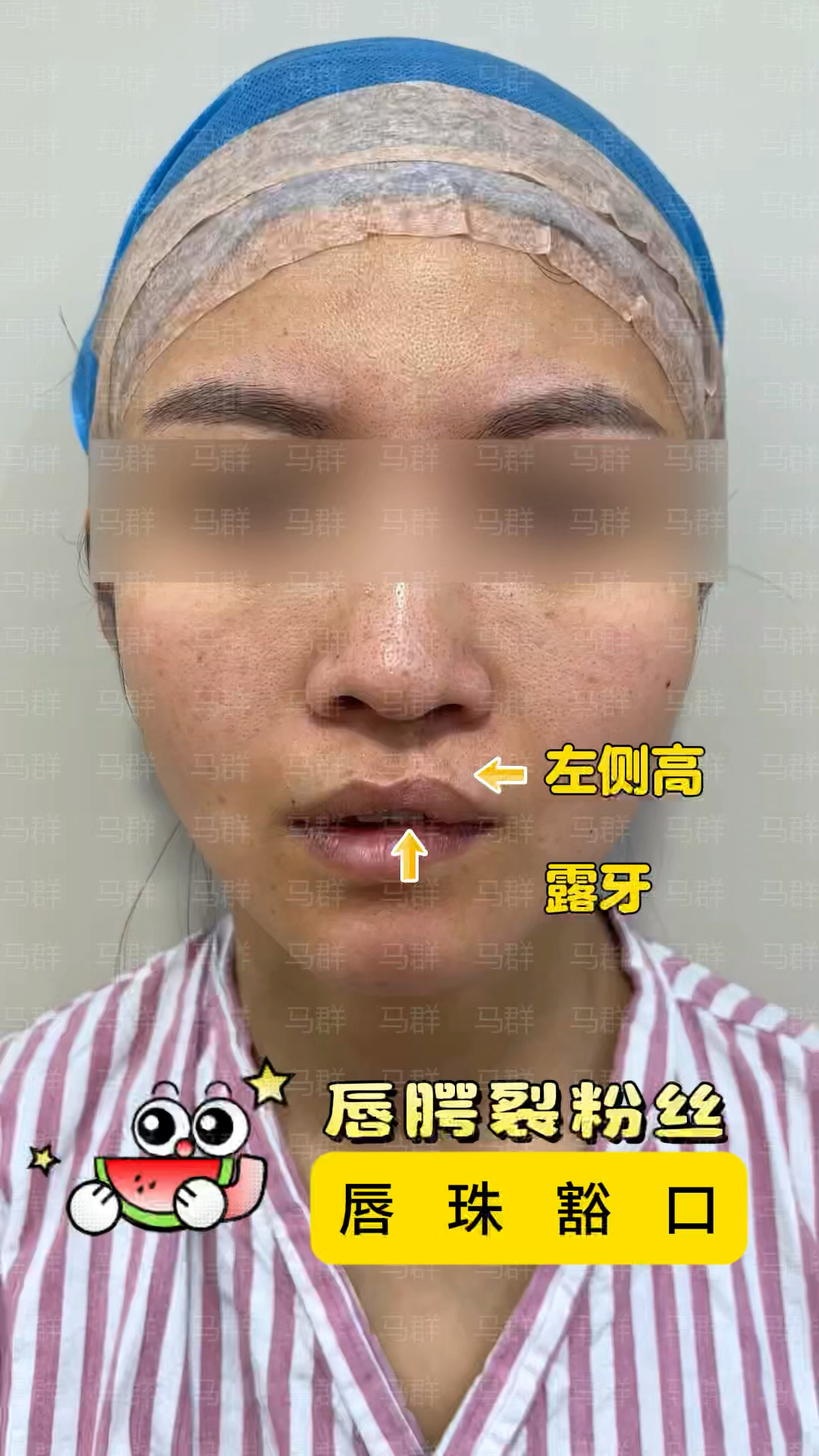 腭裂术后伤口糜烂图片图片