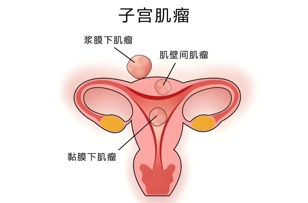 提到子宫肌瘤,大家都不陌生,作为妇科常见病,很多女性朋友都是体检时