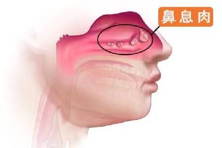 为什么会长鼻息肉