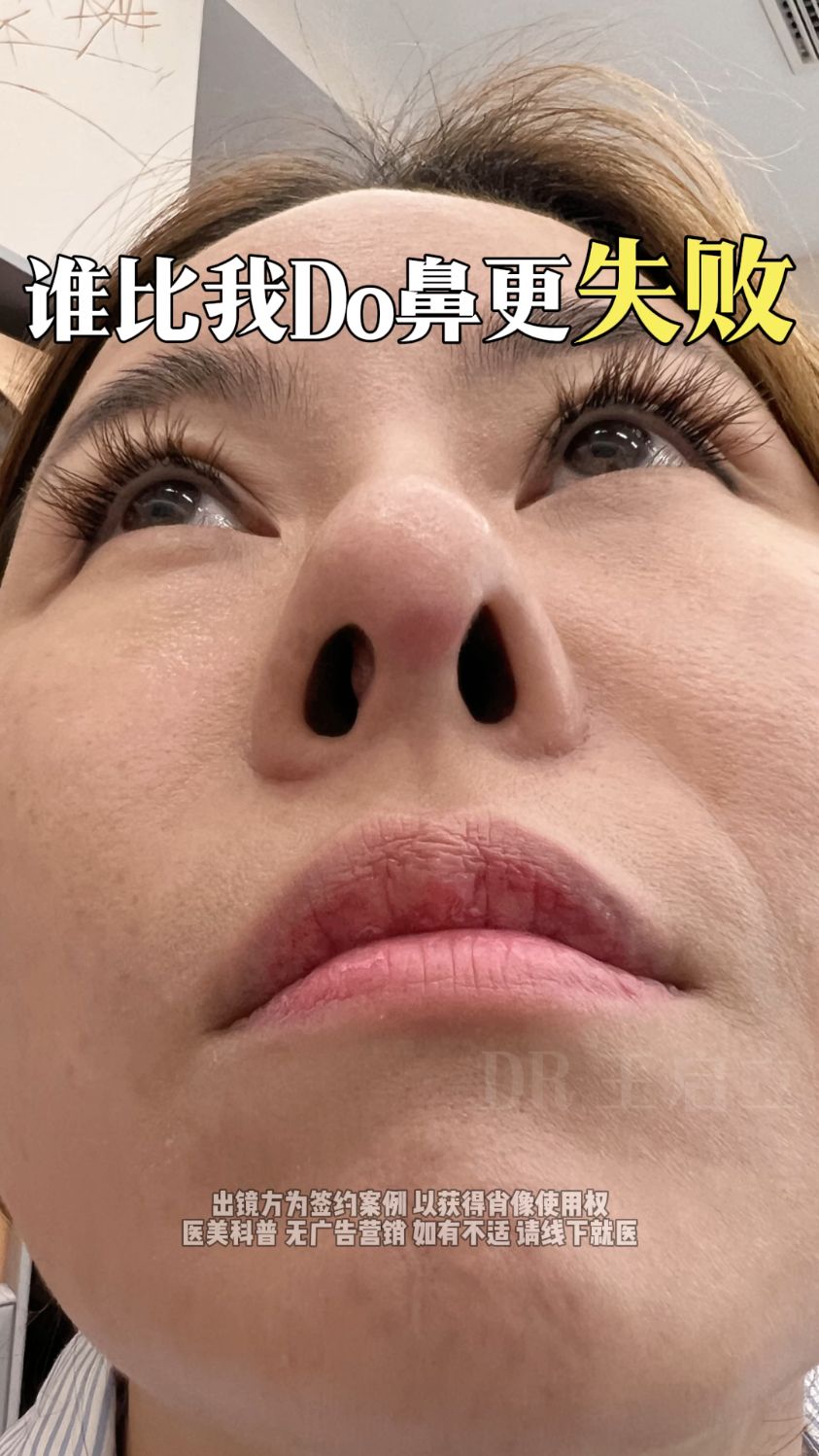 做了几次鼻子,鼻头越做越大,丑的不敢见人,典型失败案例!