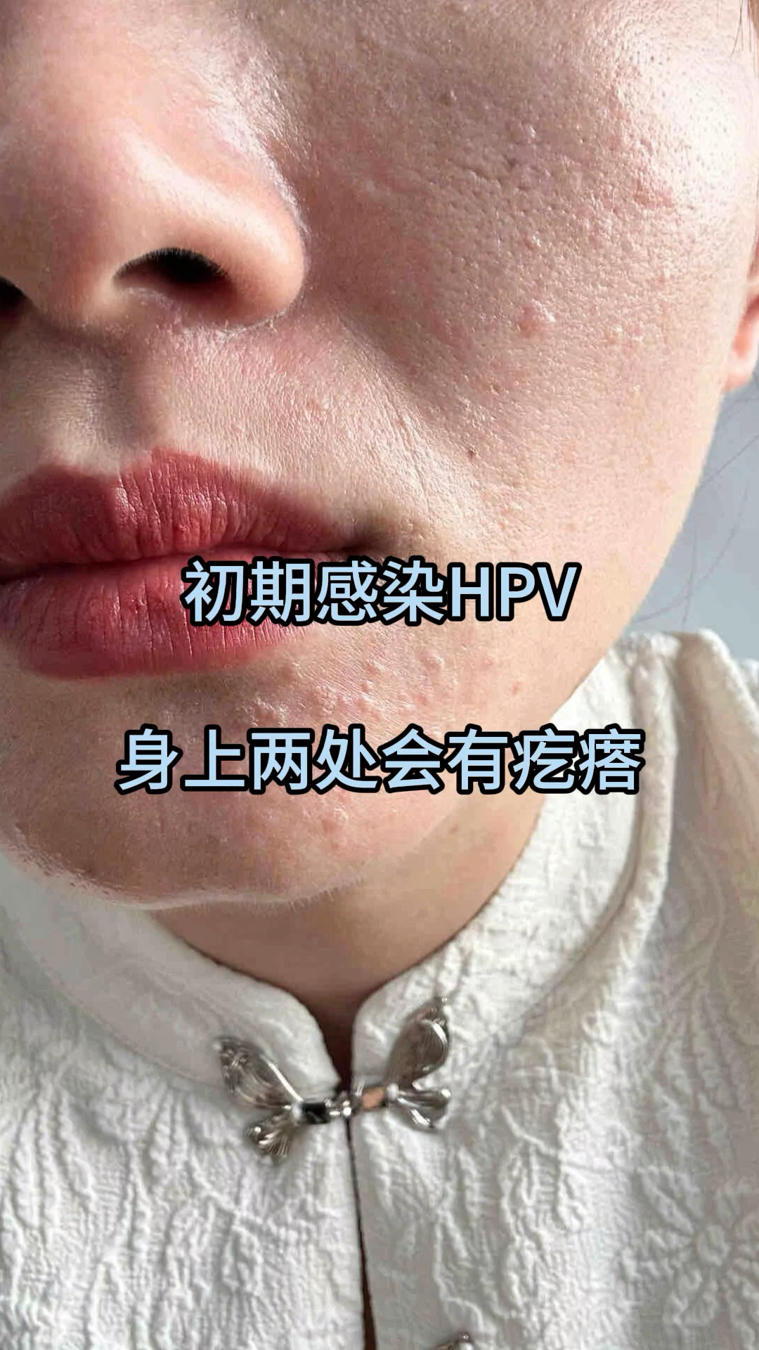 初期感染hpv,身上两处会有疙瘩