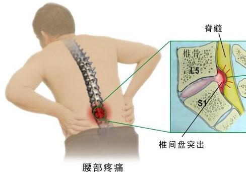 腰椎间盘突出,张仲景一方,仅4味药,散寒除湿化淤堵!