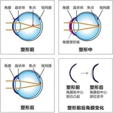 别再花冤枉钱!一篇文章免费告诉你,外面买不到的近视矫正方法!
