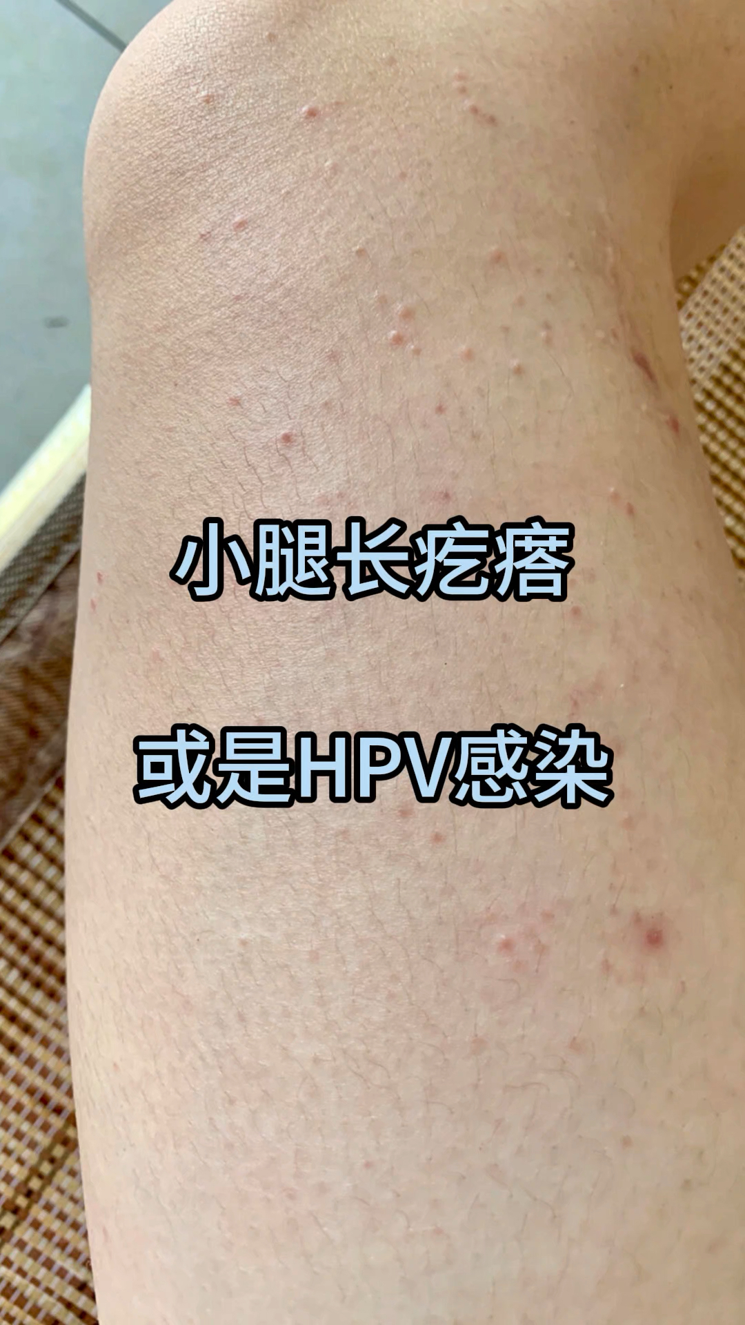 小腿长疙瘩或是hpv感染,要小心这两种腿部异常