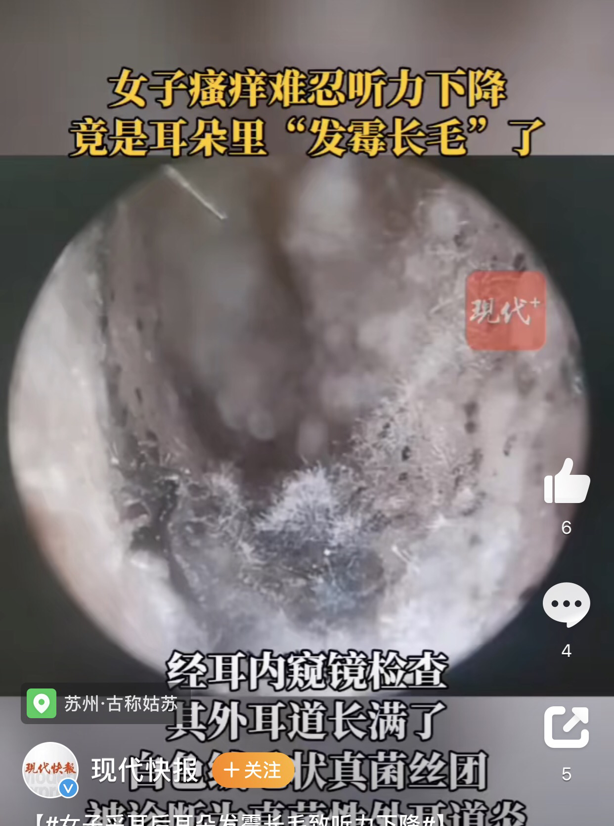 苏州,一名女子采耳后耳朵发霉长毛致听力下降!
