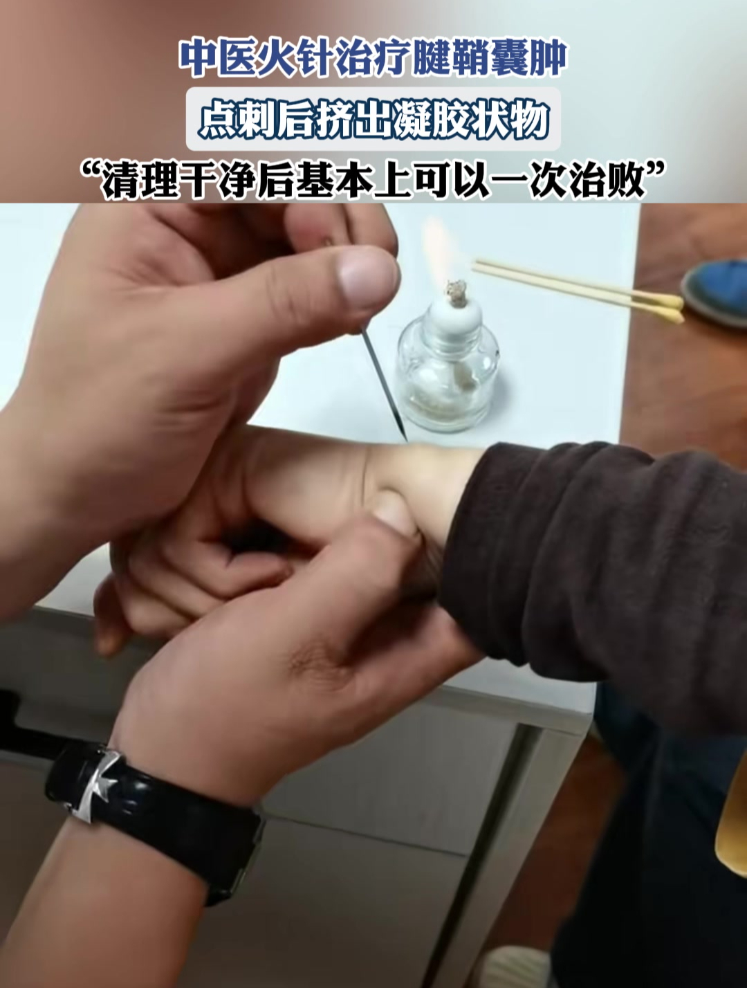 中医火针治疗腱鞘囊肿,点刺后挤出凝胶状物